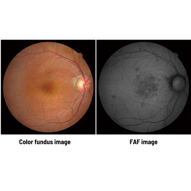 Optical Coherence Tomography / Fundus Camera Retina Scan Duo™2 Fundus autofluorescence (FAF)