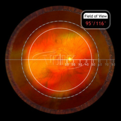 Volk SuperField NC Lens