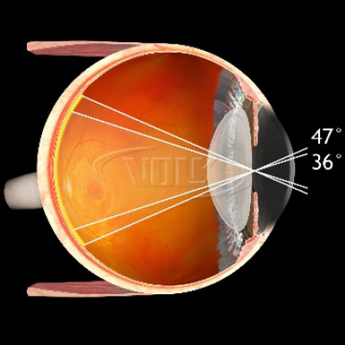 Volk 14D Aspheric Lens | INNOVA