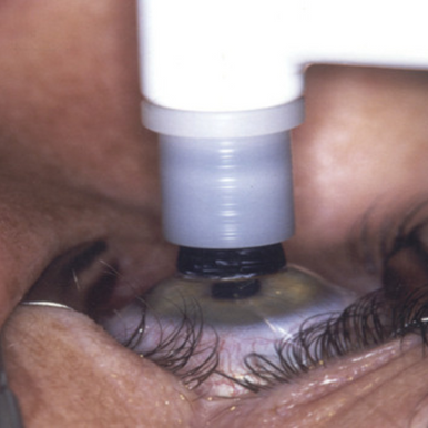 Épurateur épithélial Amoils