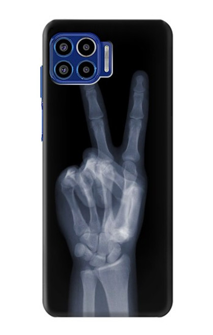 S3101 X-ray Peace Sign Fingers Case For Motorola One 5G