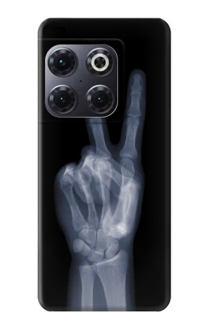 S3101 X-ray Peace Sign Fingers Case For OnePlus 10T