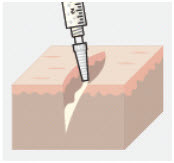 Zynrelef Bupivacaine/Meloxicam 400mg-12mg Sol 14mL 1/Vial