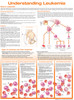 Understanding Leukemia Anatomical Chart Laminated (Poster)