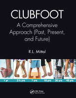 Clubfoot