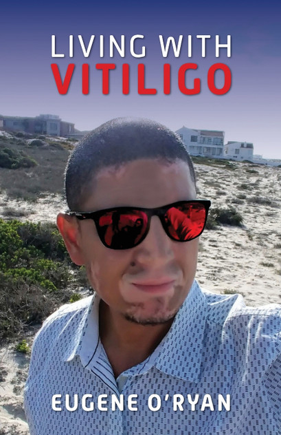 Living with Vitiligo Living with Vitiligo