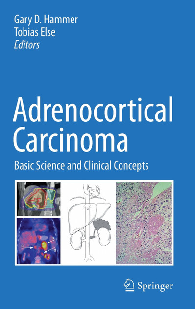 Adrenocortical Carcinoma