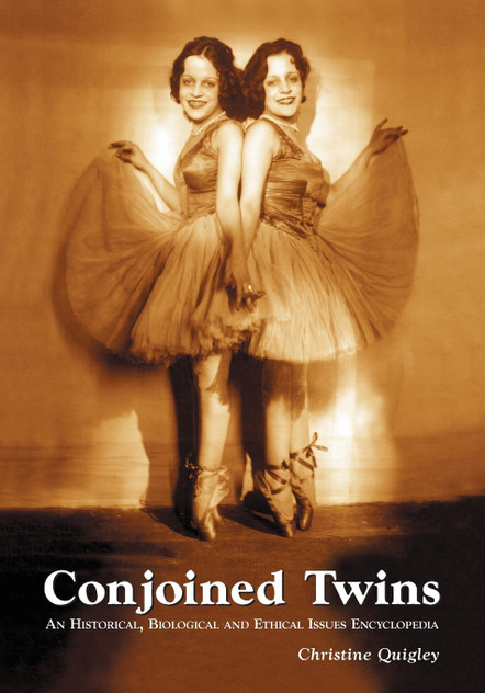 Conjoined Twins Conjoined Twins