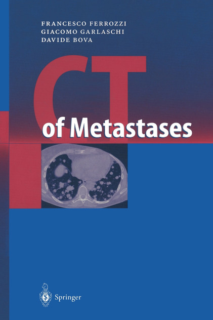CT of Metastases CT of Metastases