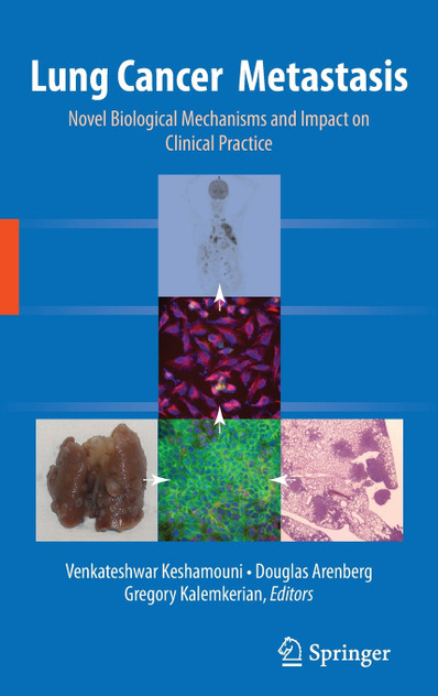 Lung Cancer Metastasis Lung Cancer Metastasis
