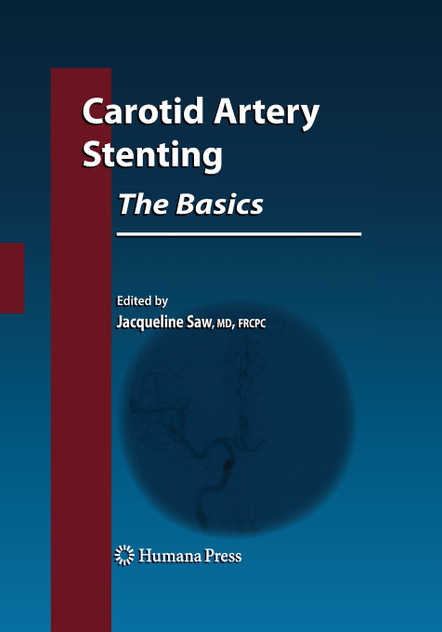 Carotid Artery Stenting Carotid Artery Stenting
