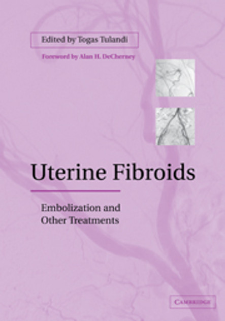 Uterine Fibroids