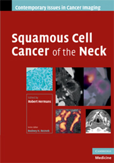 Squamous Cell Cancer of the Neck Squamous Cell Cancer of the Neck