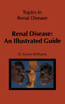 Renal Disease