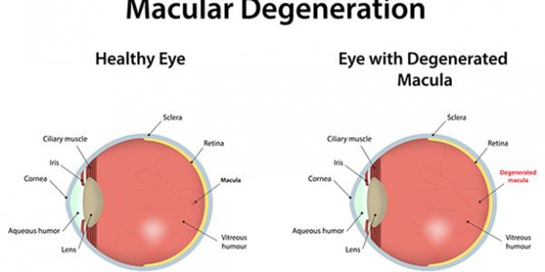 Age-Related Macular Degeneration (AMD)