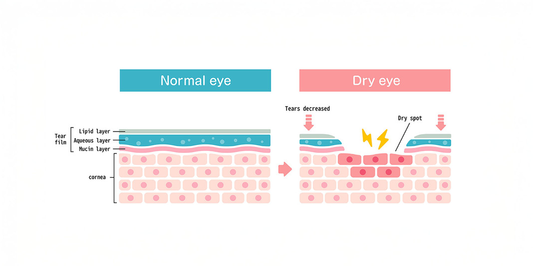 Help For Dry Eyes Help For Dry Eyes