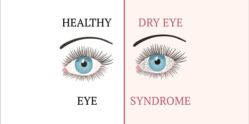 Sarah’s Health Notes: Get Dry Eyes Blinking Better 