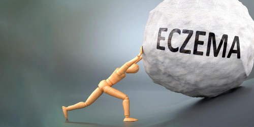 Sarah’s Health Notes: Natural ways to help soothe eczema