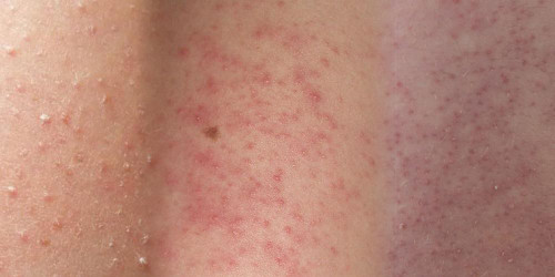 Treatment of Keratosis Pilaris – Chicken Skin