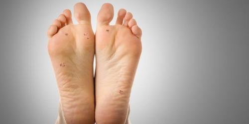 Treatment of Warts and Verrucas
