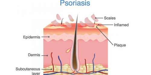 What I Have Learnt Since Having Psoriasis