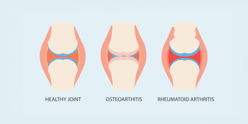 Differences Between Osteoarthritis & Rheumatoid Arthritis