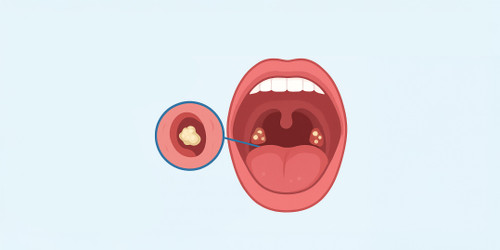 Tonsillar Stones: Causes, Prevention, and Practical Approaches