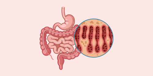 What Is Leaky Gut Syndrome?