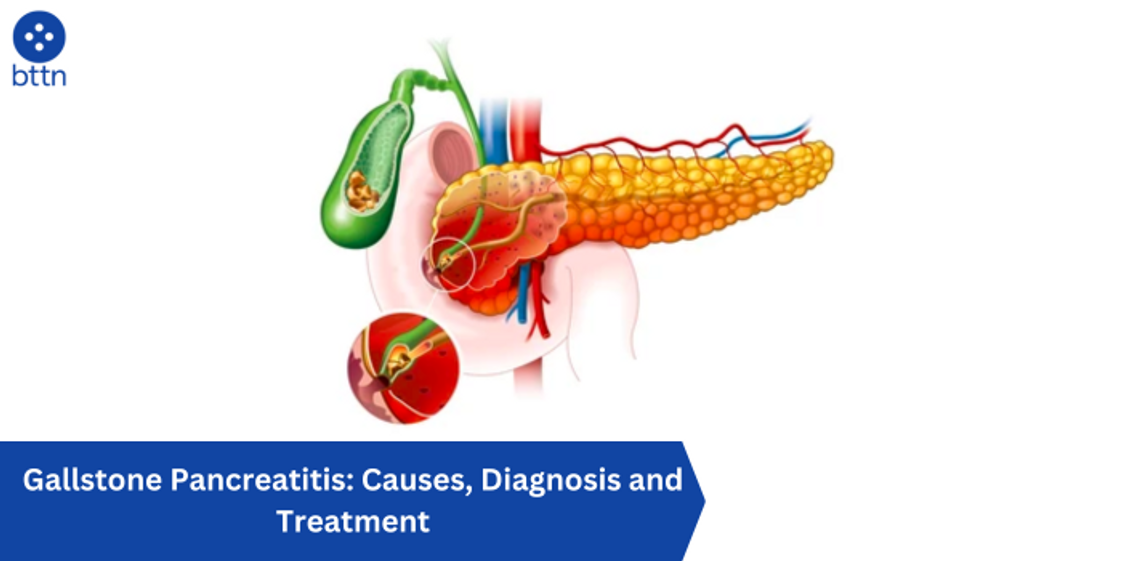 Gallstone Pancreatitis: Causes, Diagnosis and Treatment