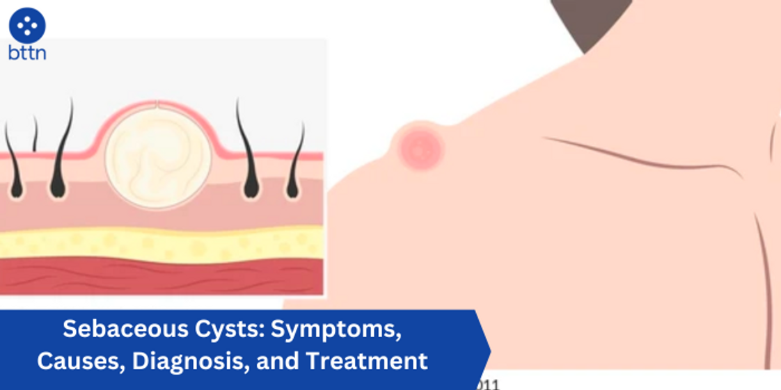 Sebaceous Cysts: Symptoms, Causes, Diagnosis, and Treatment