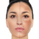 Hyperpigmentation