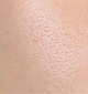 Oily Skin