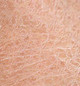 Dry Skin