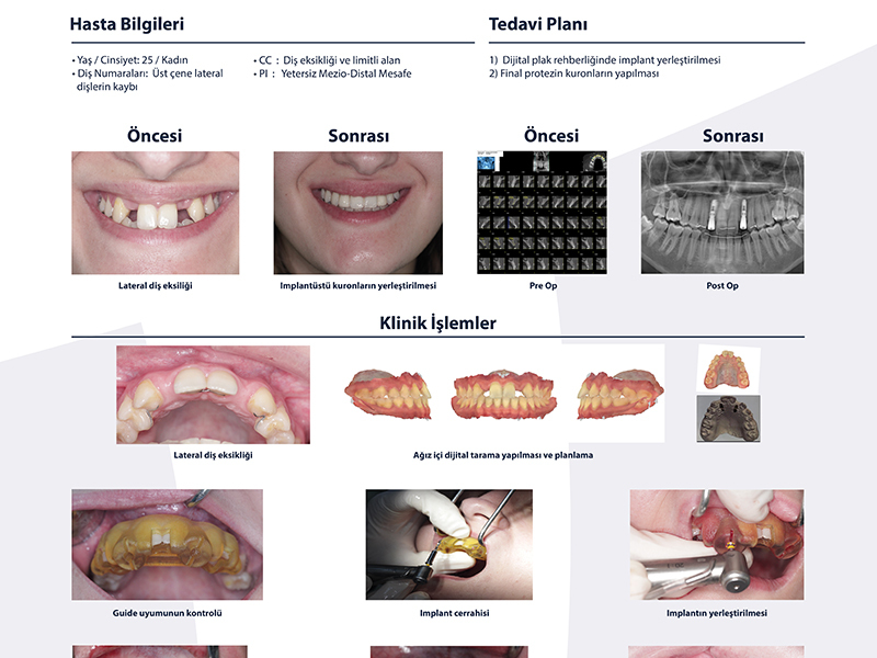 Dijital Plak ve Implant - Dr. Esra Ondur