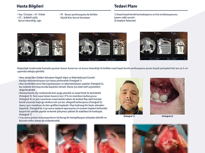 Implant Tedavileri - Dr. Mustafa Dağ