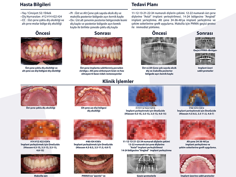 OneGuide ve Implant - Dr. Tolga Kodaz