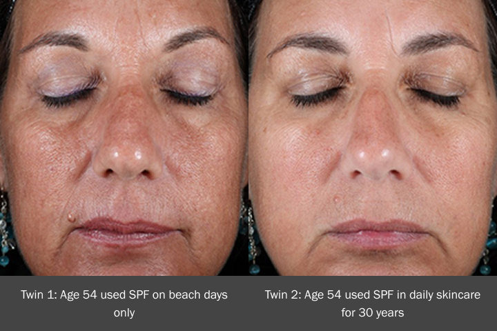 Side-by-side comparison of 54-year-old twins showing skin aging—left used SPF occasionally, right used SPF daily for 30 years