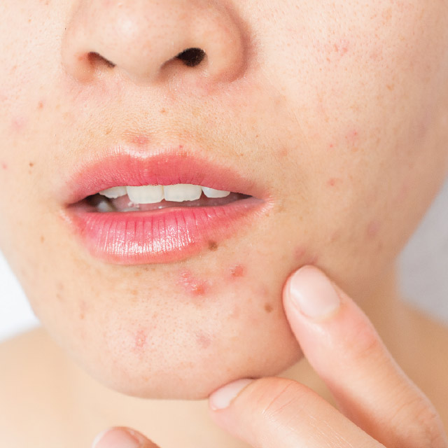Understanding The Basics of Acne