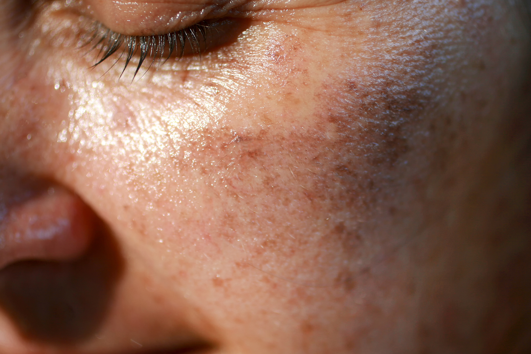 How to Remove and Get Rid of Sun Spots