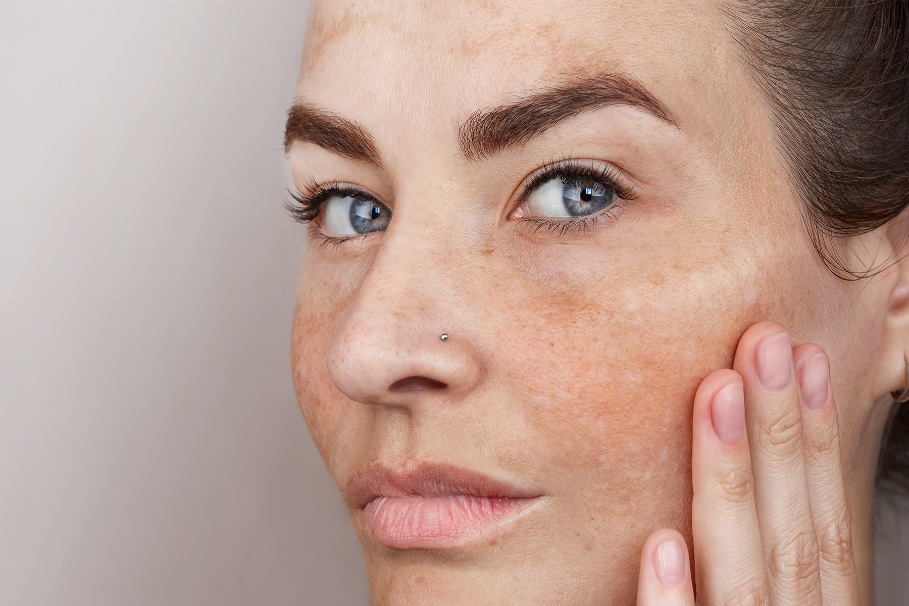 Hyperpigmentation Causes and Treatment Solutions