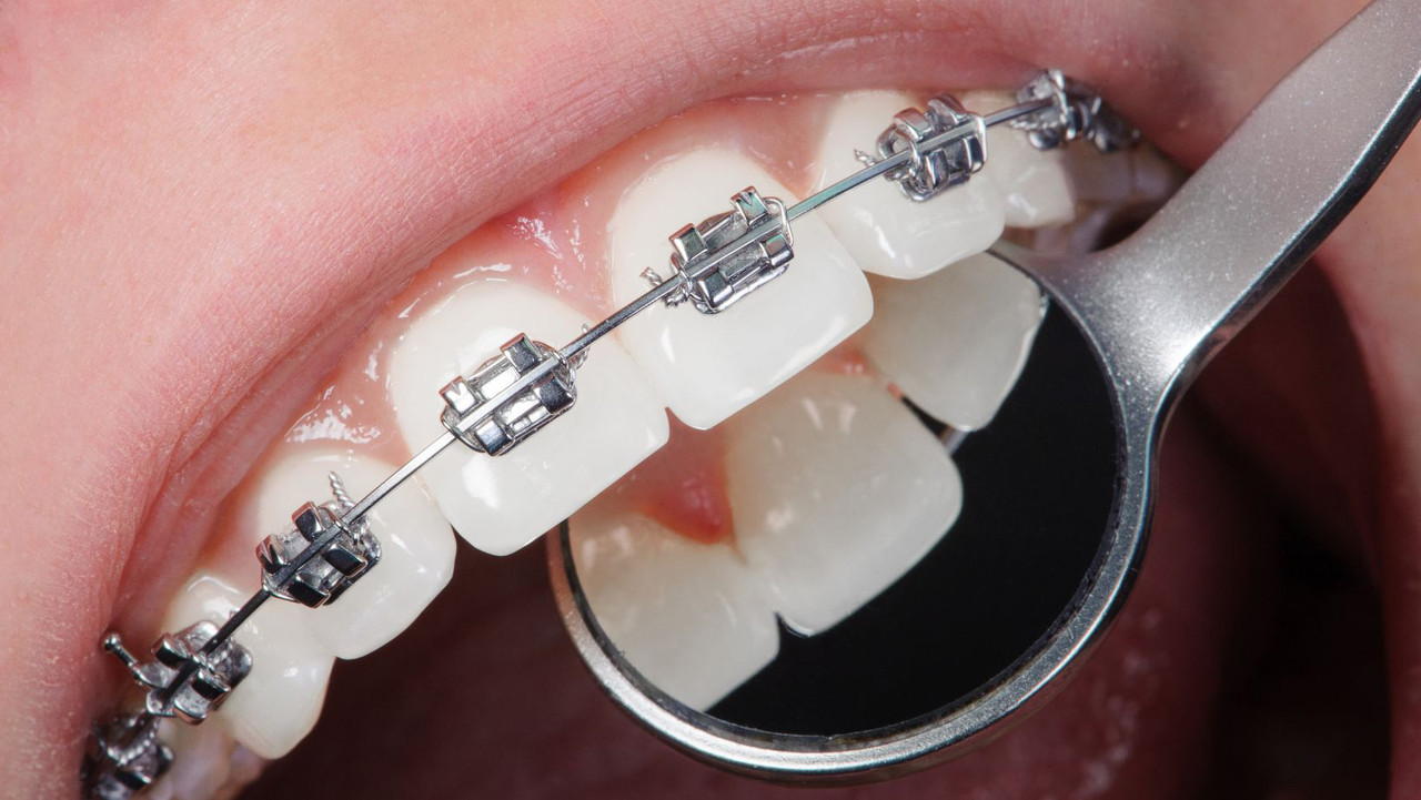 Dental orthodontic wire nitinol nickel titanium