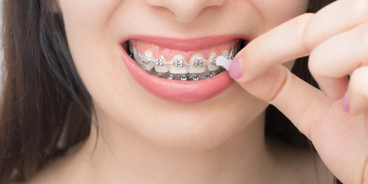 Orthowax, a Genuine Orthodontic Dental Wax for Braces Made In U.S