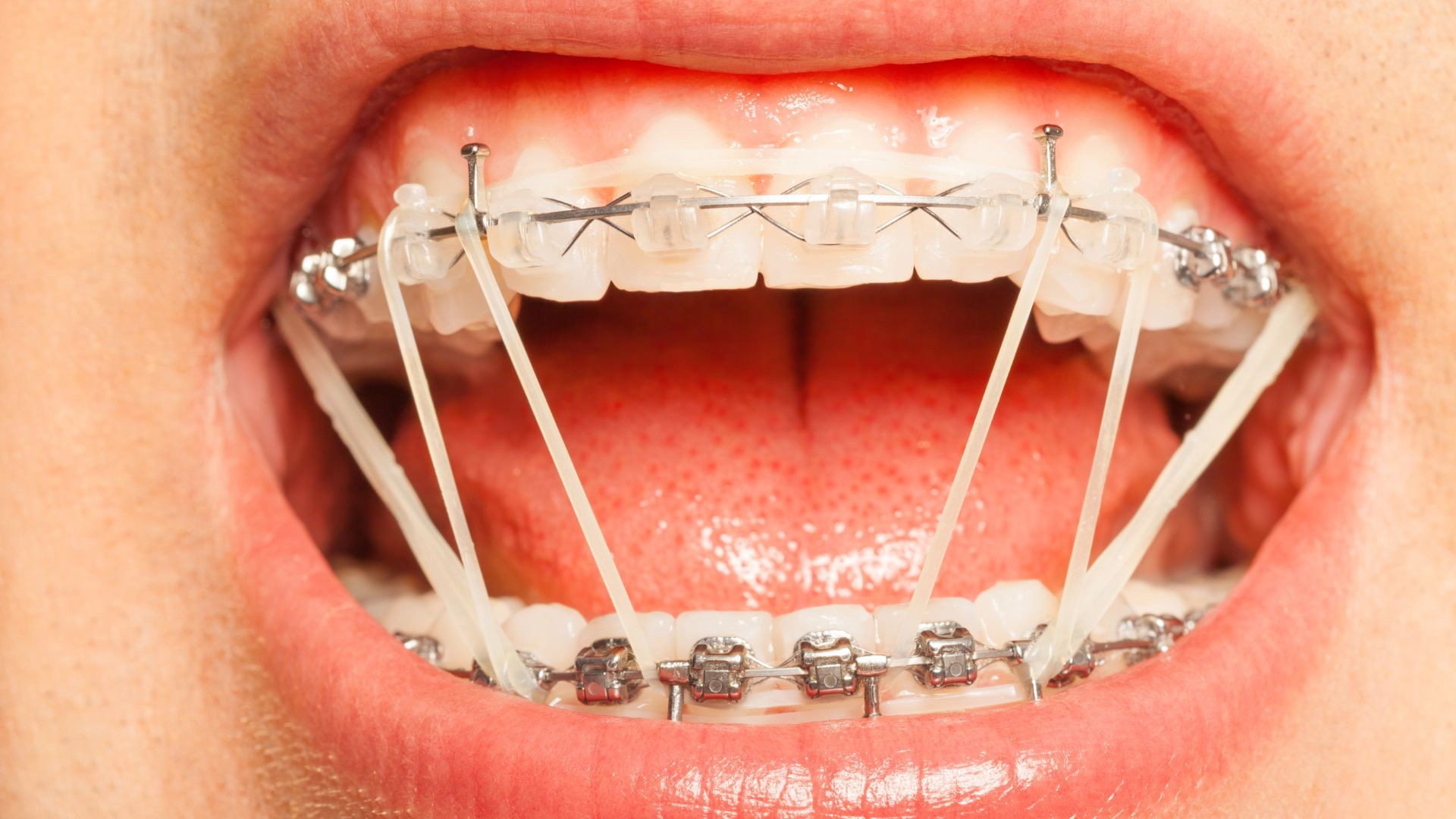 Why Orthodontic Rubber Bands Matter - Wiewiora & Dunn Orthodontics