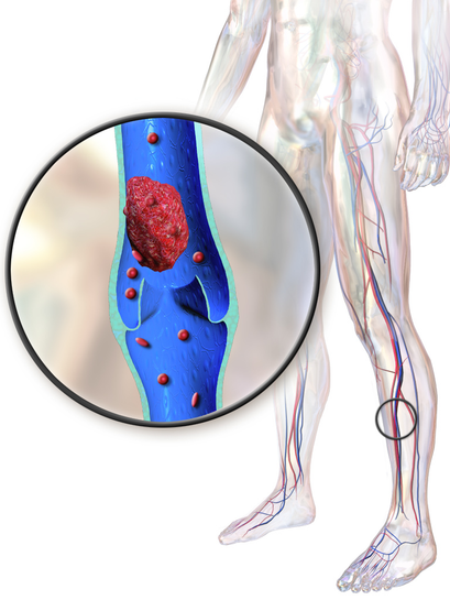 Deep Vein Thrombosis Anatomical Chart