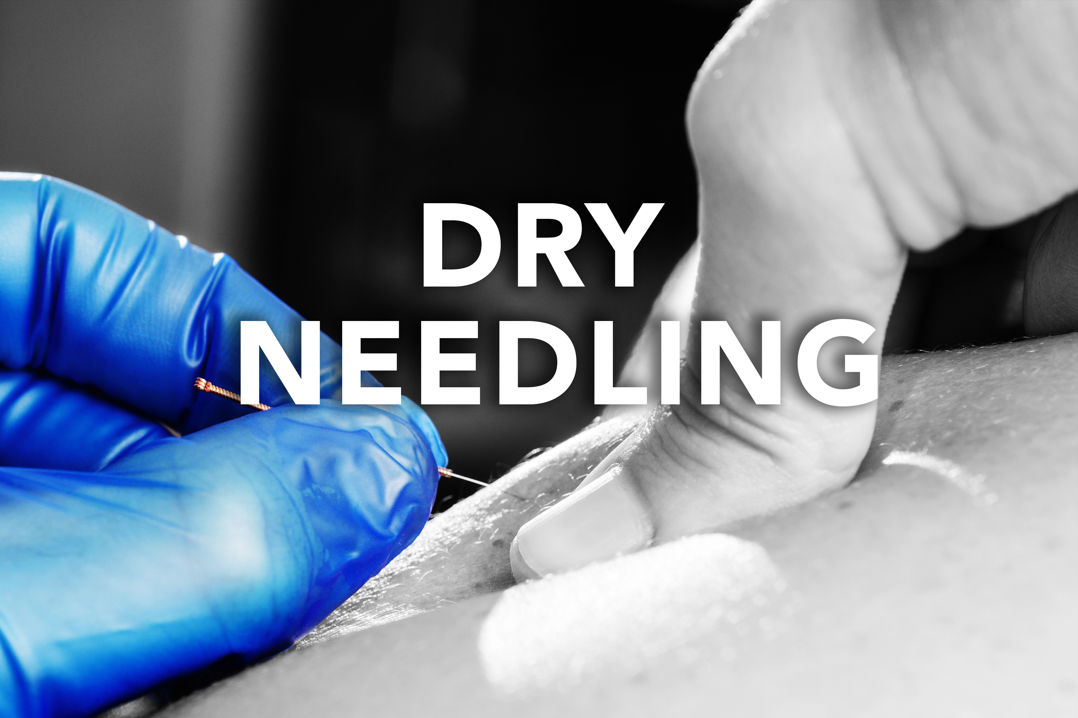 Dry Needling