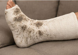 Keeping It Clean: Dirty white leg cast showing the everyday challenge of keeping a cast clean