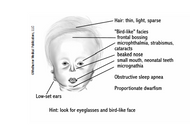 Pediatric Board Review Question - Hallermann-Streiff Syndrome (HSS) - Symptoms 