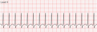 Pediatric Board Practice Question Treatment for  SVT