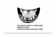 Pediatrics Board Question/ Ectodermal Dysplasia