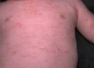 Pediatric Board Review Question / Clinical Vignette/  Rashes